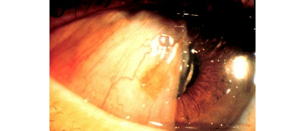 Pterygium Management: ‘Winging It’ - Mivision