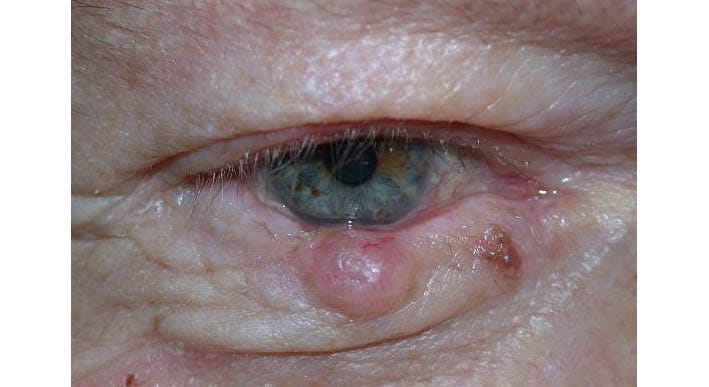 papilloma eyelid margin