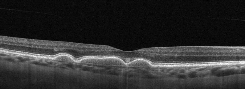 Monitoring Dry AMD - Image 5 (1782)