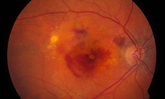Monitoring Dry AMD - Image 6 (1782)