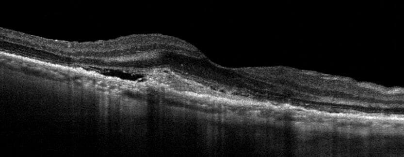 Monitoring Dry AMD - Image 7 (1782)