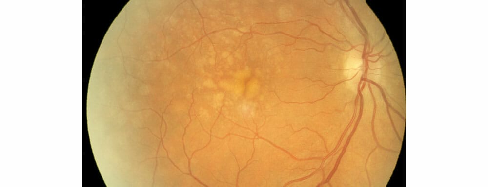 Monitoring Dry AMD - Image 4 (1782)