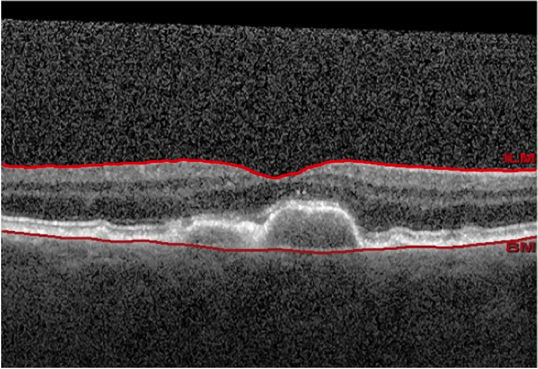 Ellex Releases First Study Results for 2RT - Image 1 (5531)