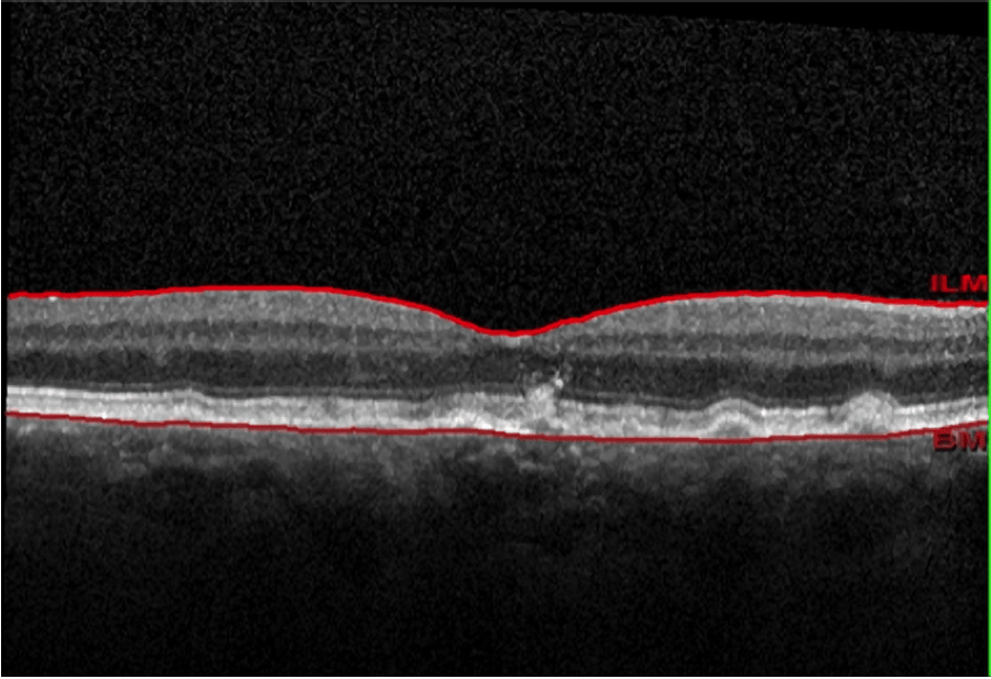 Ellex Releases First Study Results for 2RT - Image 2 (5531)