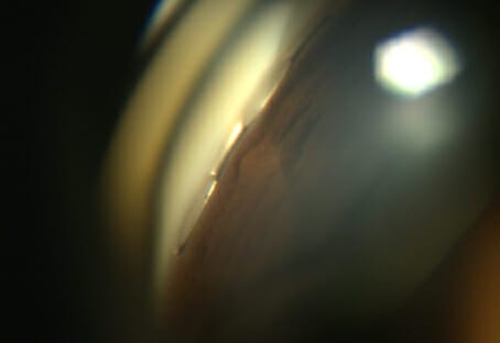 Minimally Invasive Glaucoma Surgery - Image 3 (6843)