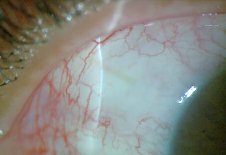 Minimally Invasive Glaucoma Surgery - Image 4 (6843)