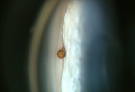 Minimally Invasive Glaucoma Surgery - Image 5 (6843)