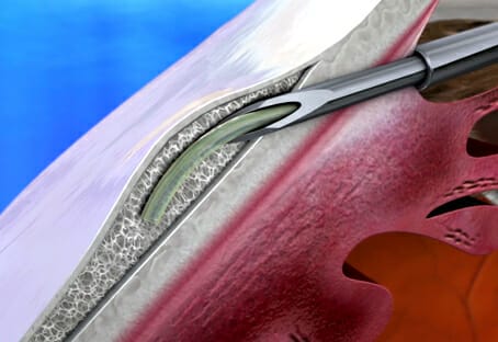 Minimally Invasive Glaucoma Surgery - Image 6 (6843)