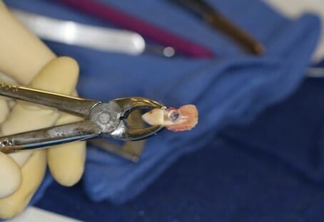 Osteoodonoto Keratoprosthesis Success in Australia mivision