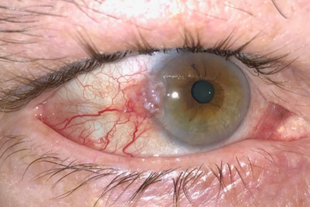 conjunctival intraepithelial neoplasia