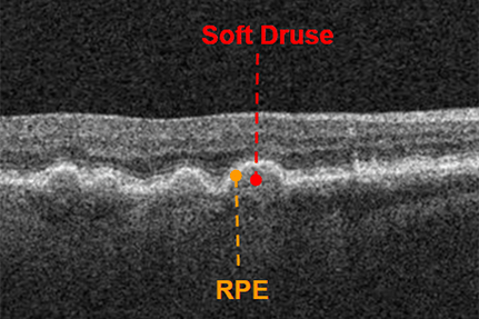 OCT and Me: A Beginner’s Guide - mivision