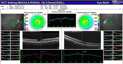 OCT and Me: A Beginner’s Guide - mivision