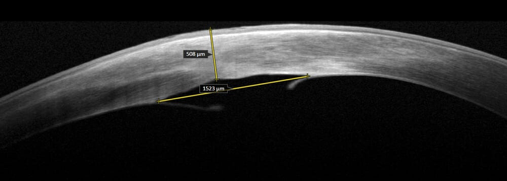 Patient Management from Keratoconus to Corneal Hydrops - mivision