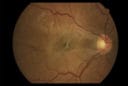 Epiretinal Membrane – A Practical Review - mivision