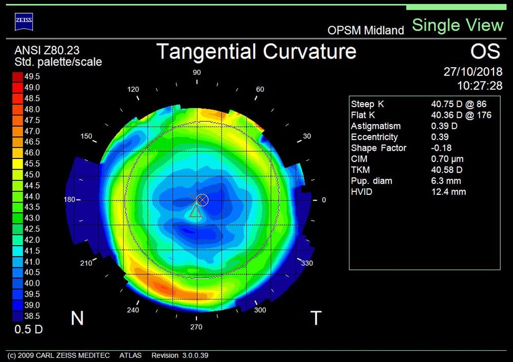 PostLASIK Myopia & OK A Case Study mivision
