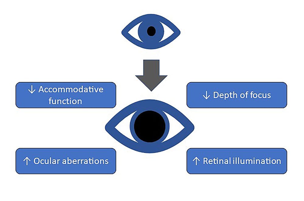 Visual Field Testing Is Pupil Dilation a Compromise? mivision