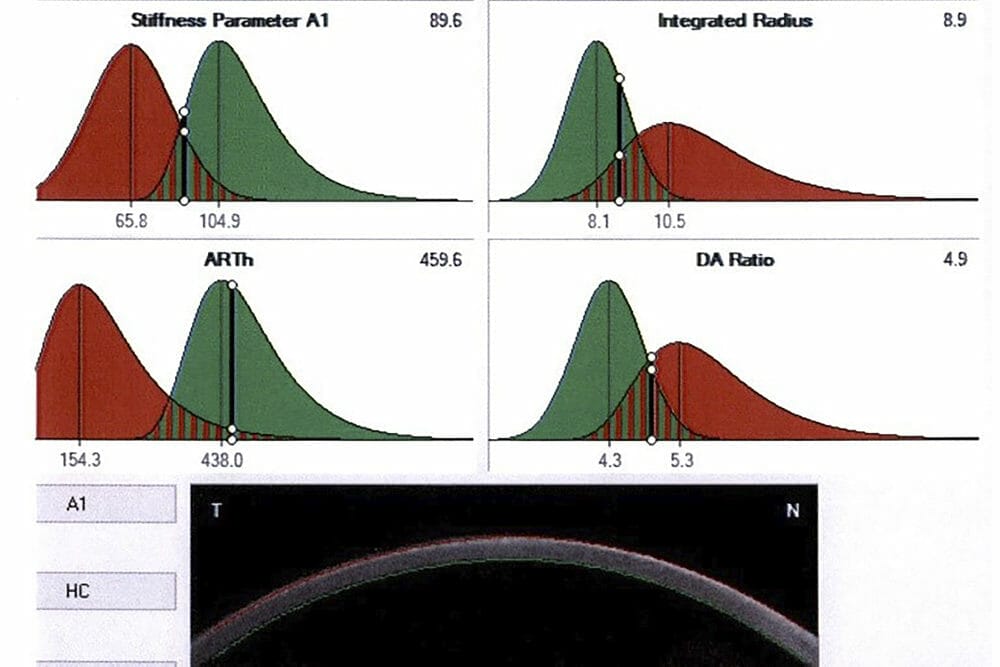Laser Vision Correction: Past, Present and Future - mivision