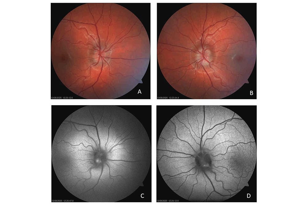 Frontiers | The double-edged sword of inflammation in inherited retinal  degenerations: Clinical and preclinical evidence for mechanistically and  prognostically impactful but treatable complications