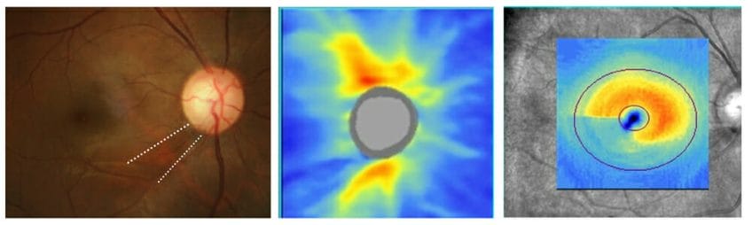 24-2C Visual Field Testing: Glaucoma Management’s Paradigm Shift ...
