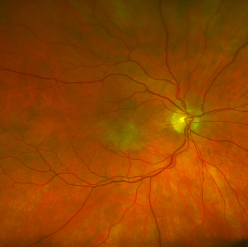 Cataract Surgery in Patients with Retinal Disease A Practical Review mivision