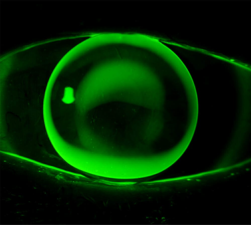 Managing Keratoconus Rigid Contact Lens Options mivision