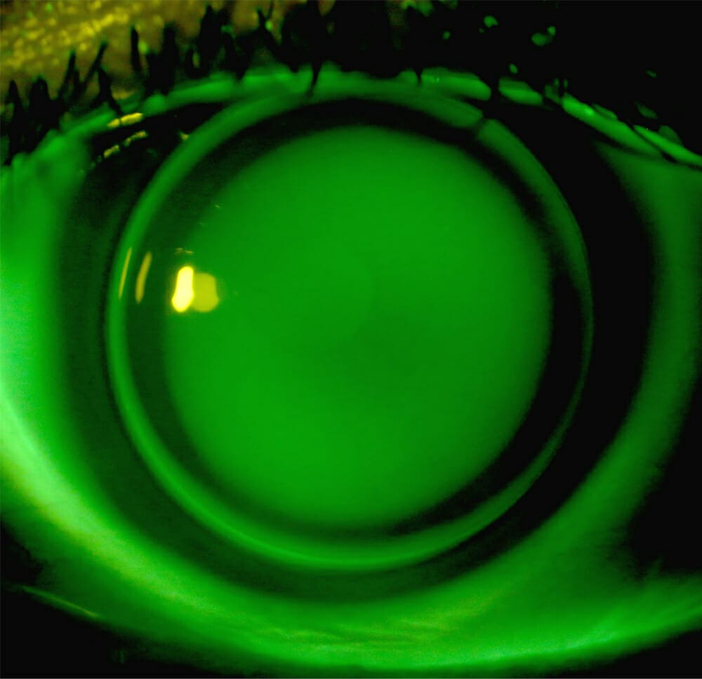 Managing Keratoconus Rigid Contact Lens Options - Mivision