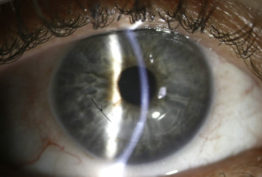 Australian First Surgery for Keratoconus - mivision