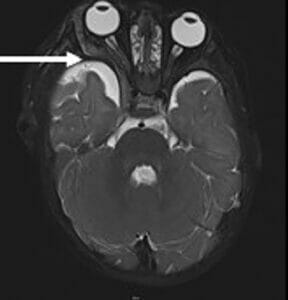 neurofibromatosis type 1 mri