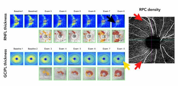 New Frontiers In Glaucoma Imaging - Mivision