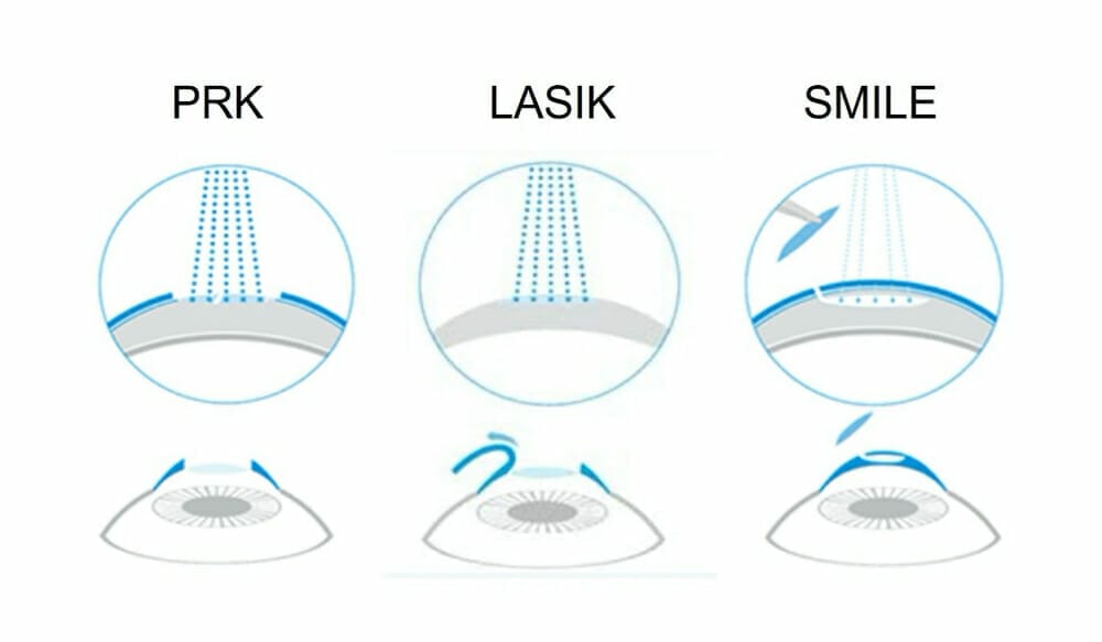 Laser Refractive Surgery Options - Mivision