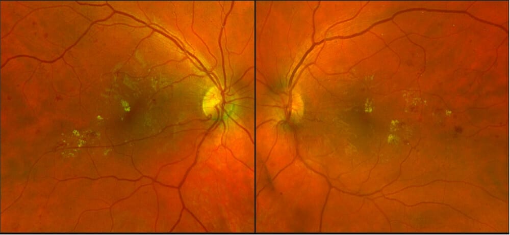 Diabetic Macular Oedema: Current and Emerging Treatments - mivision