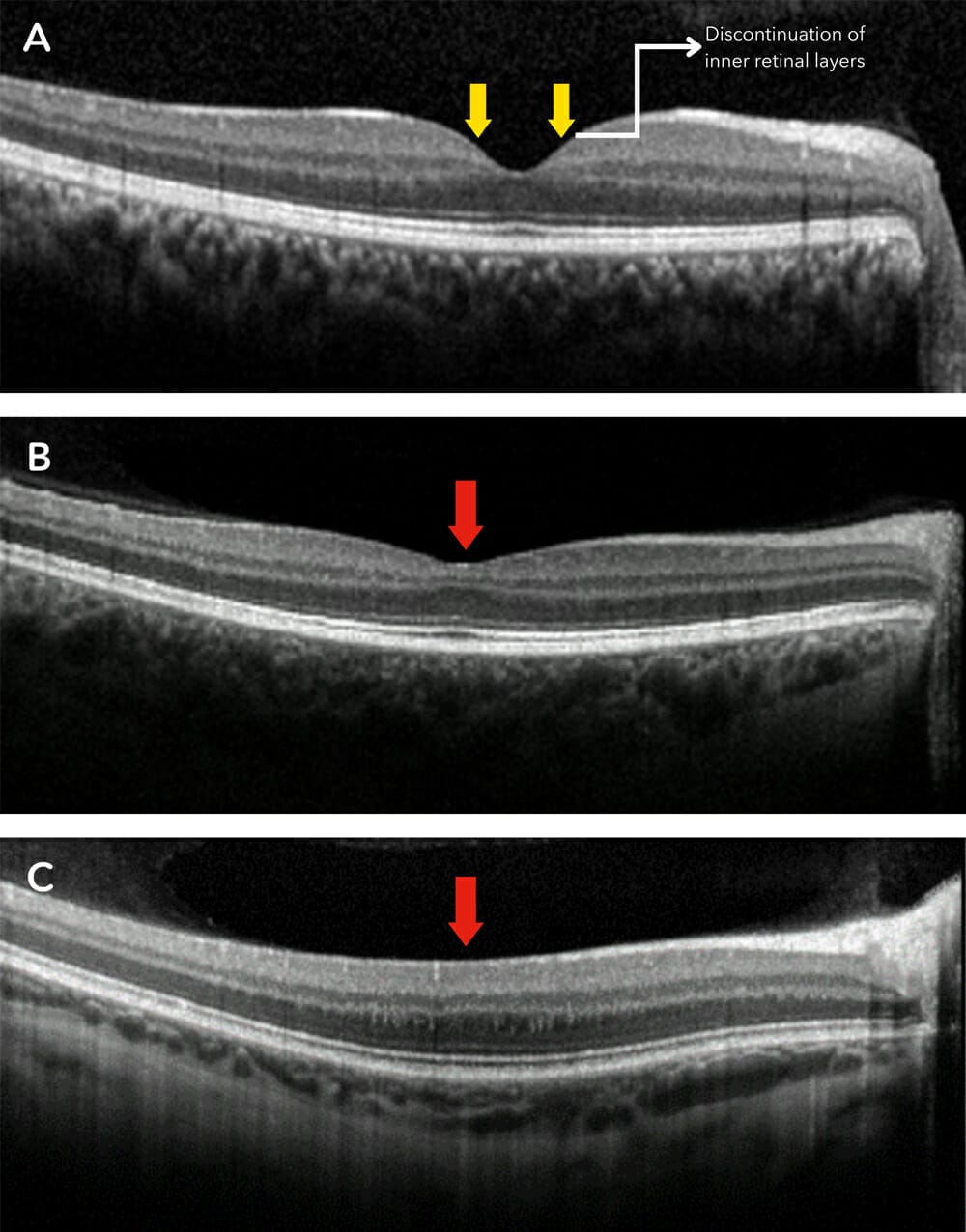 Foveal Hypoplasia Diagnosis with OCT & Clinical Management - mivision