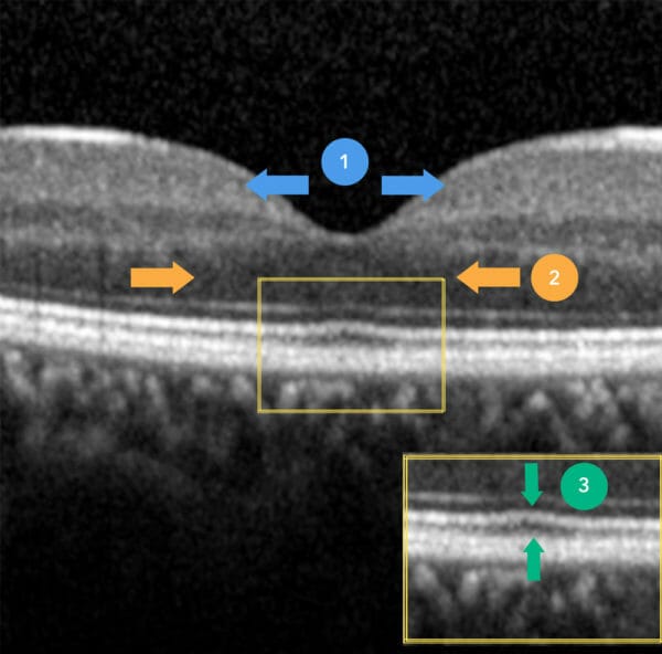 Foveal Hypoplasia Diagnosis with OCT & Clinical Management - mivision