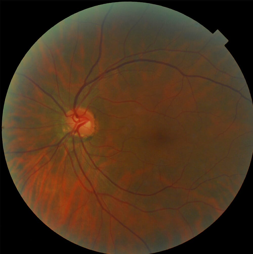 Toxic Optic Neuropathy An Unspoken Cause of Vision Loss mivision