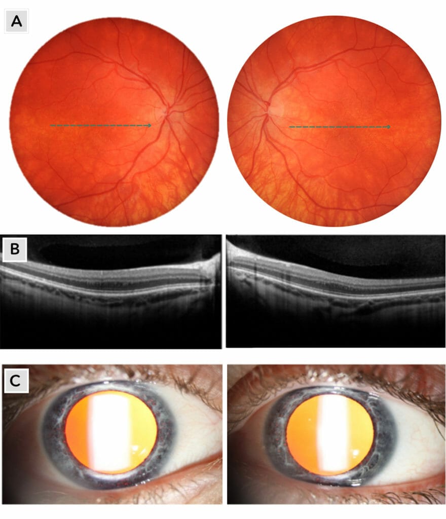 Foveal Hypoplasia Diagnosis with OCT & Clinical Management - mivision