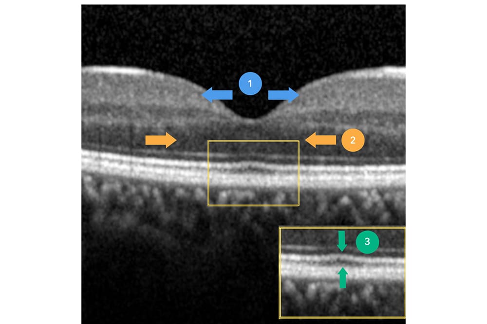 Foveal Hypoplasia Diagnosis with OCT & Clinical Management - mivision