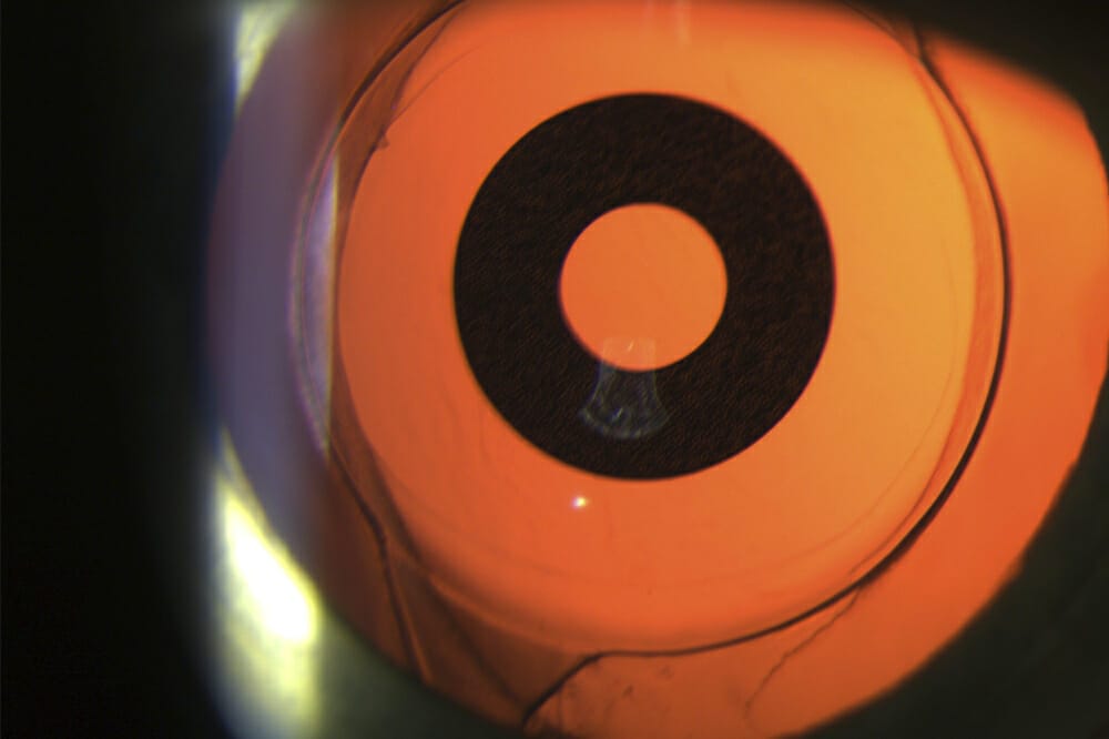 Cataract Surgery and The Retina Keeping Out of Trouble mivision