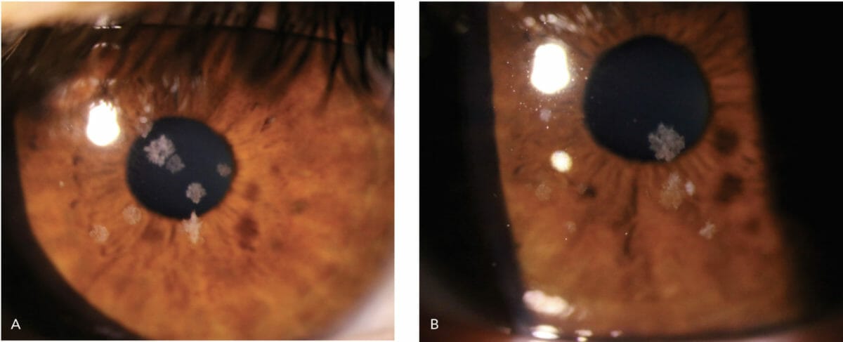 Recognising Corneal Dystrophies Mivision