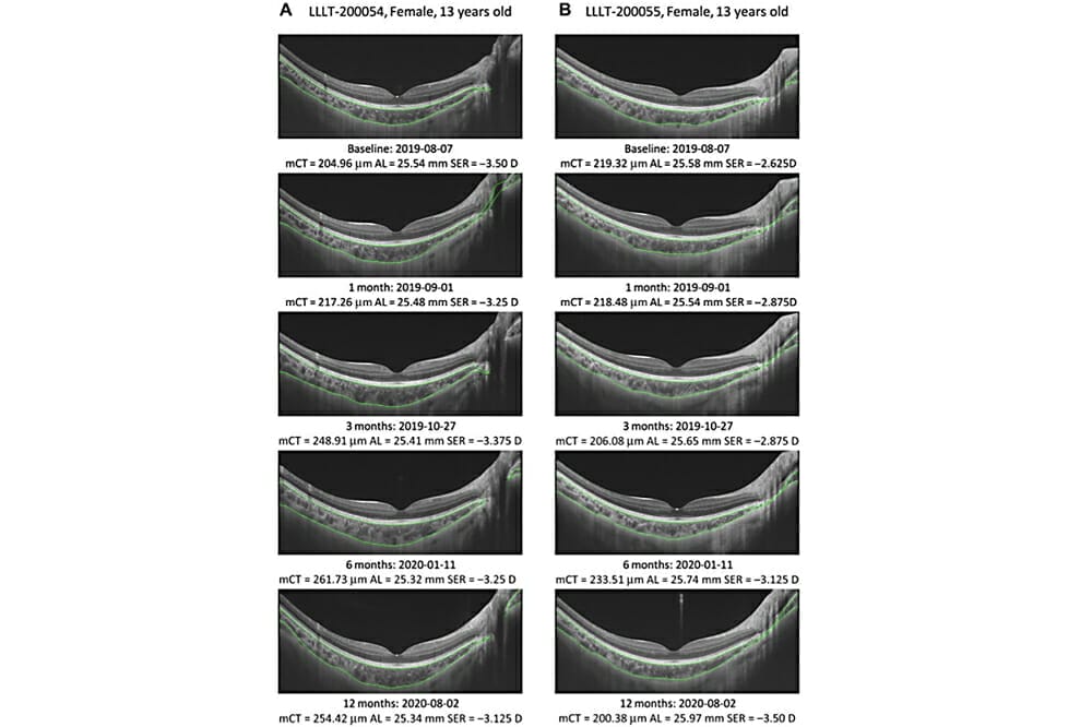 Myopia: Repeated low-level red-light therapy