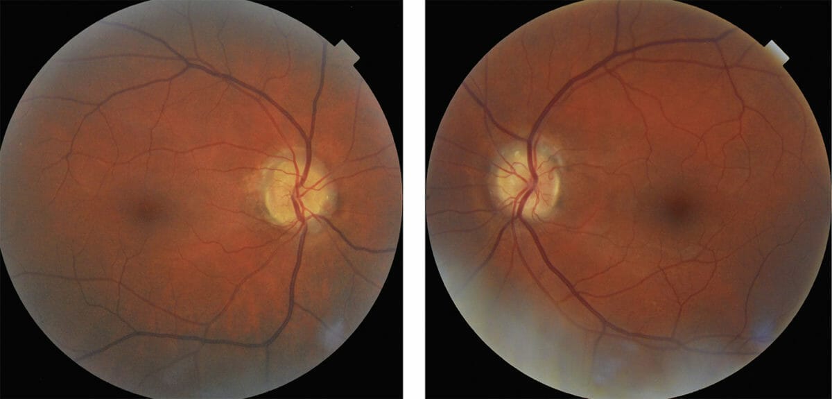 Navigating Visual Fields in Optic Nerve Head Drusen mivision