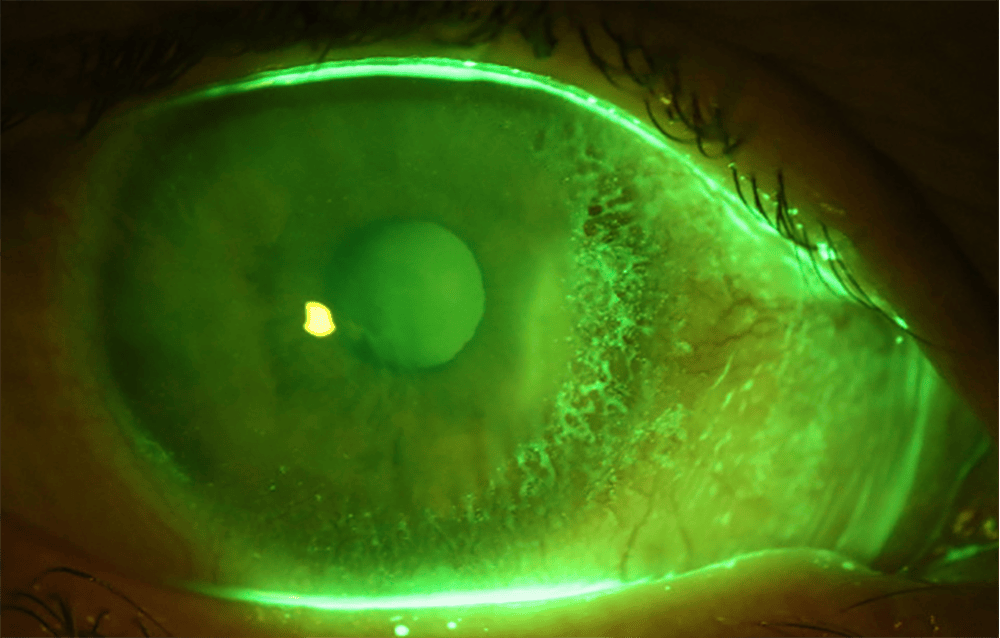 Causes And Management Lipid Keratopathy In Scleral Lens Wearers Mivision 2779