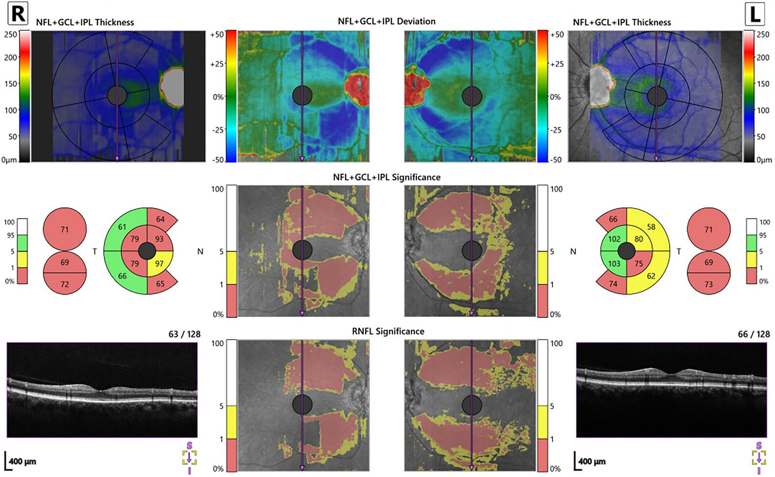 Navigating Visual Fields in Optic Nerve Head Drusen mivision