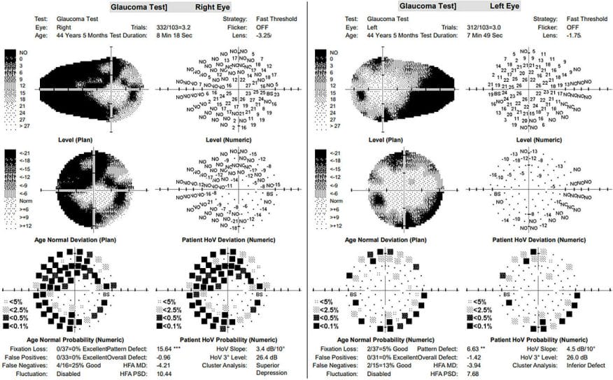 Navigating Visual Fields in Optic Nerve Head Drusen - mivision
