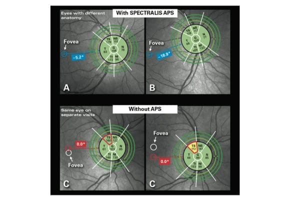 Spectralis Glaucoma Module Premium Edition - mivision
