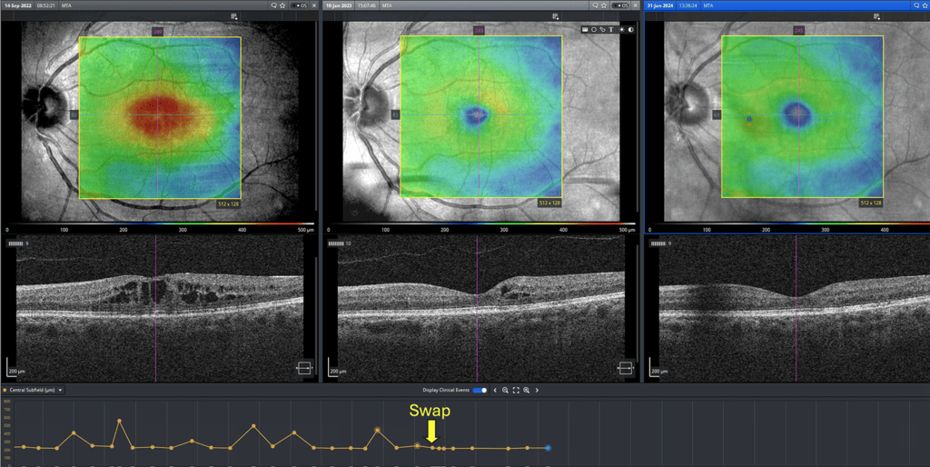 Faricimab Real World Treatment for AMD and DMO - mivision