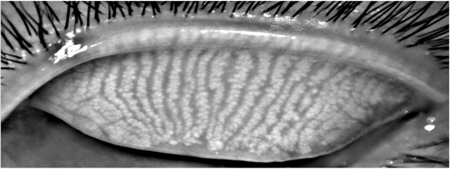 Figure 2: Normal meibomian gland, with glands running parallel and for the full length of the eye lid. Images courtesy of the Clinical Research Centre, University of California Berkley.6