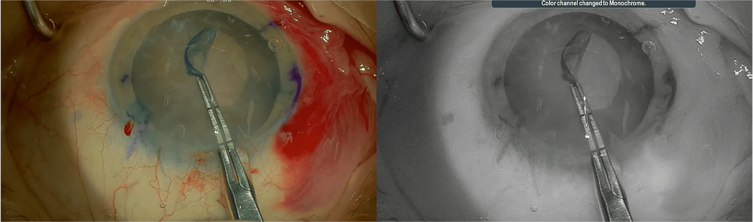 View of eye surgery using different filters available in the Alcon Ngenuity 3D visualisation system.