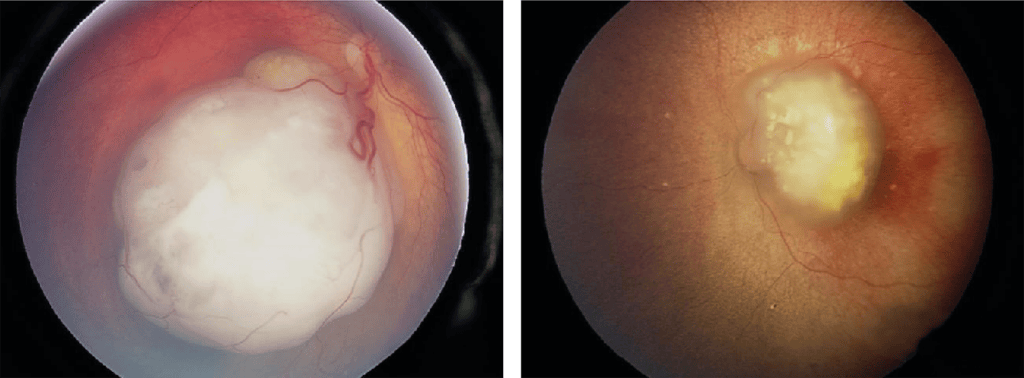 Image of two patients with retinoblastoma that presented with strabismus.