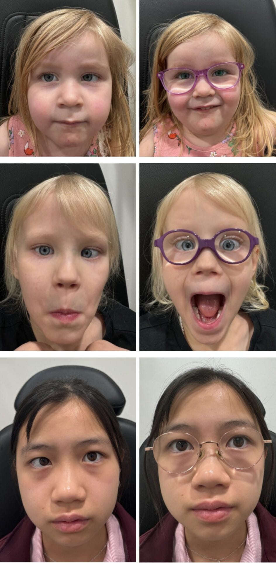 Figure 2. Three patients with hypermetropia and accommodative esotropia.