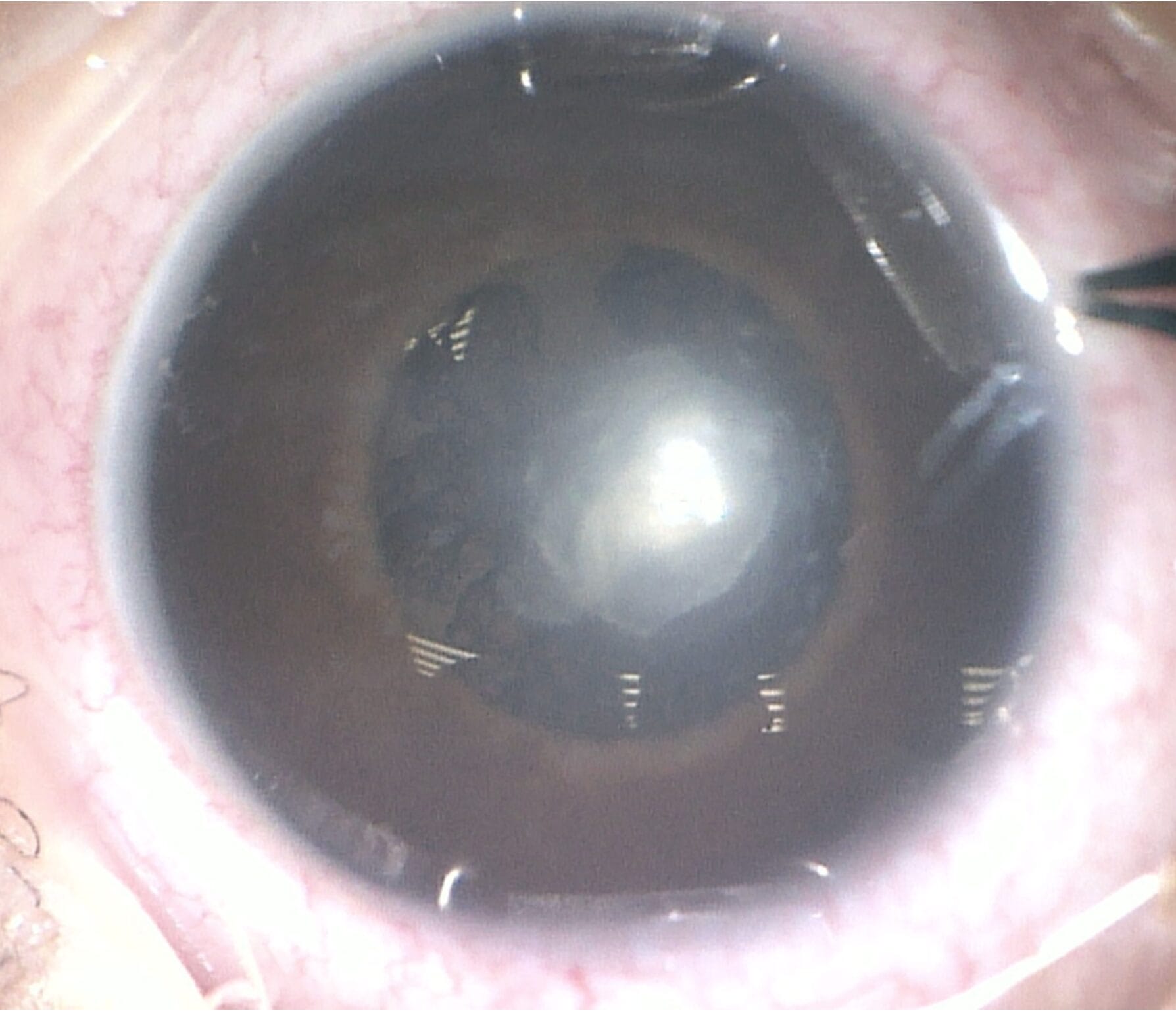 Image of Joseph’s right cataract.